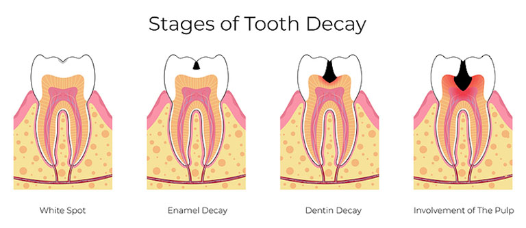 các giai đoạn của sâu răng