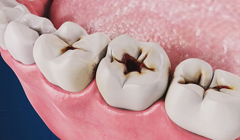 các giai đoạn của sâu răng