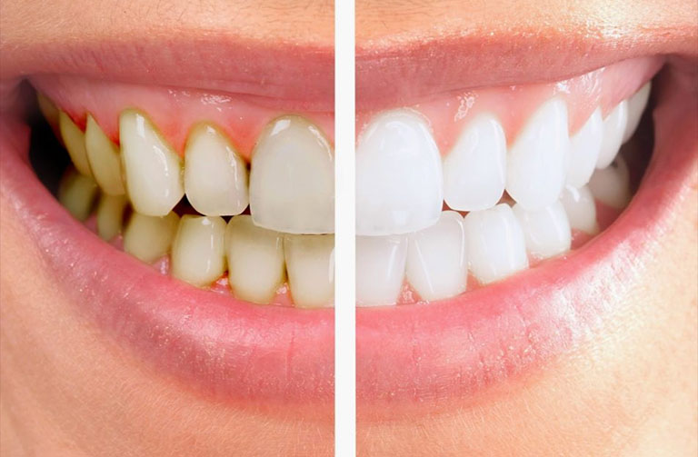 10 cách lấy cao răng tại nhà