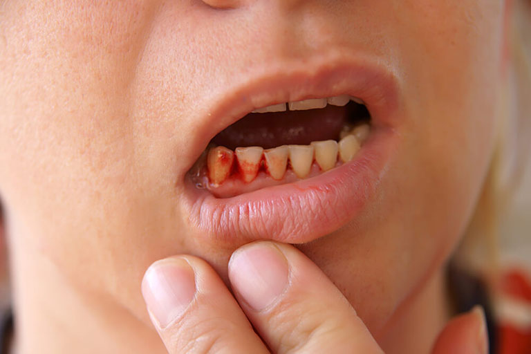 chảy máu chân răng thiếu chất dinh dưỡng gì