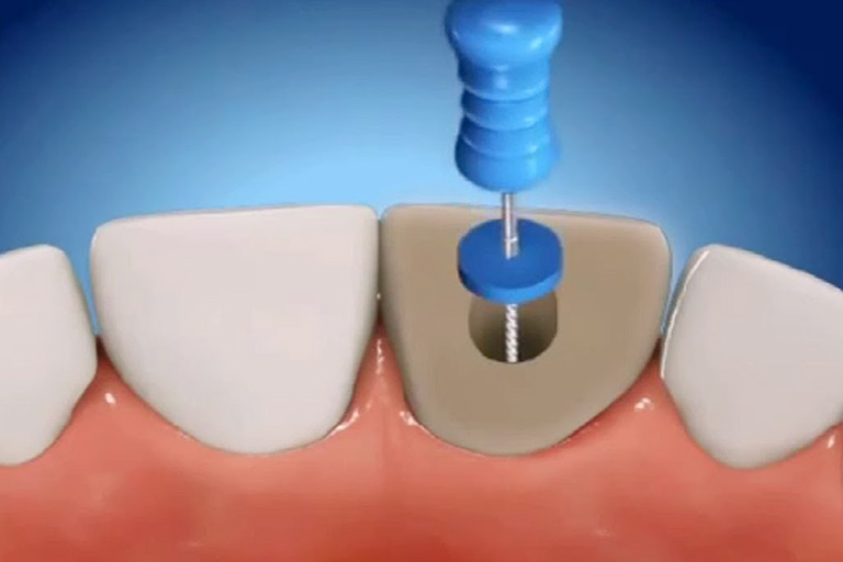Cách bước cơ bản trong quy trình lấy tủy răng cửa