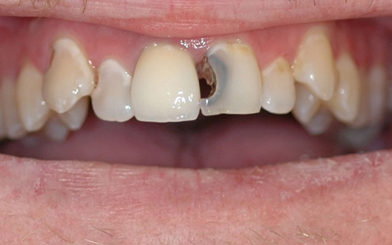 Tiến hành loại bỏ mô bệnh và trám răng nếu tủy mới chớm viêm, có thể hồi phục được