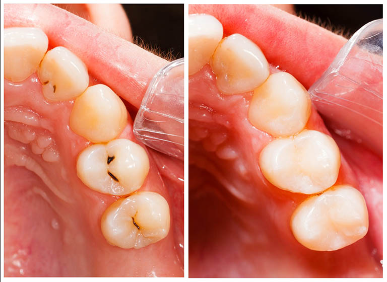 con sâu răng có hình dạng như thế nào