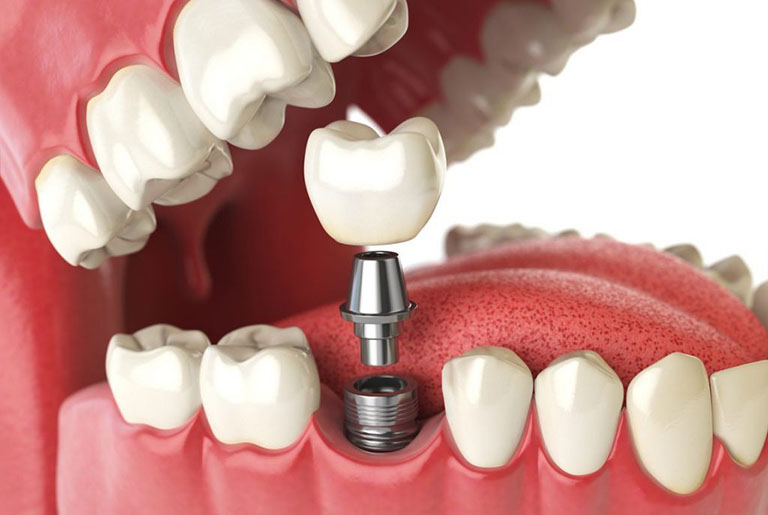 trồng răng implant tại tphcm ở đâu uy tín
