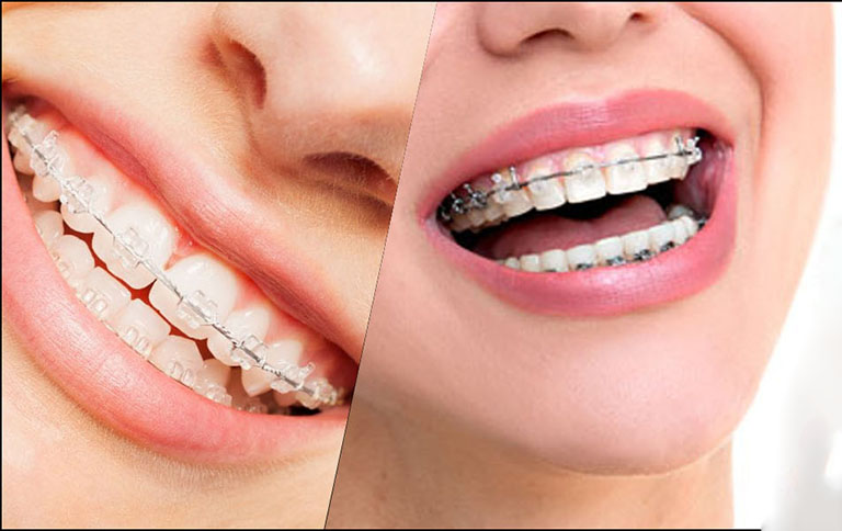 niềng răng giá bao nhiêu tiền