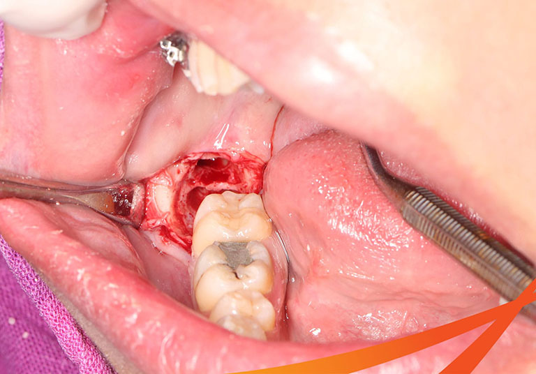 quá trình lành vết thương sau khi nhổ răng khôn