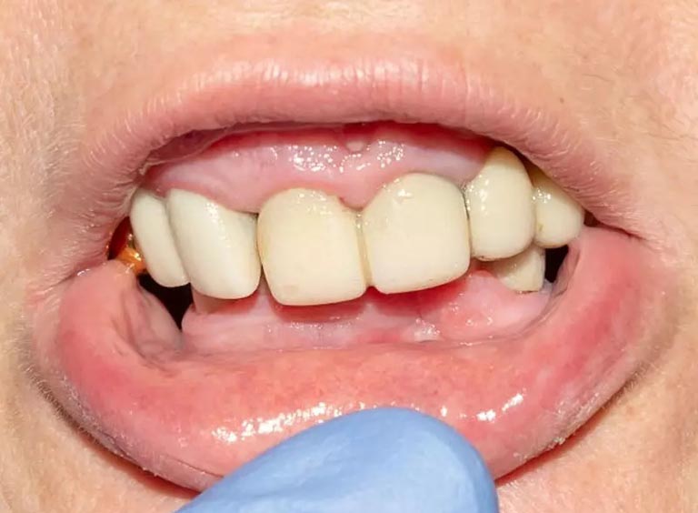 nguyên nhân răng bị đen
