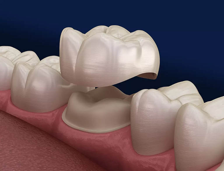 răng chết tủy tồn tại được bao lâu
