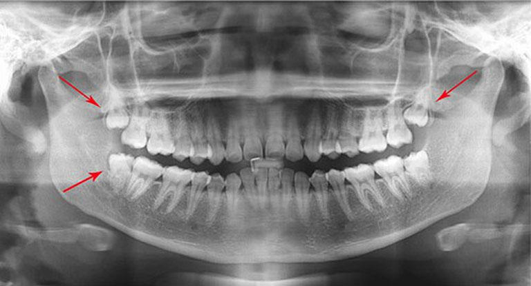 răng khôn hàm trên mọc lệch ra má