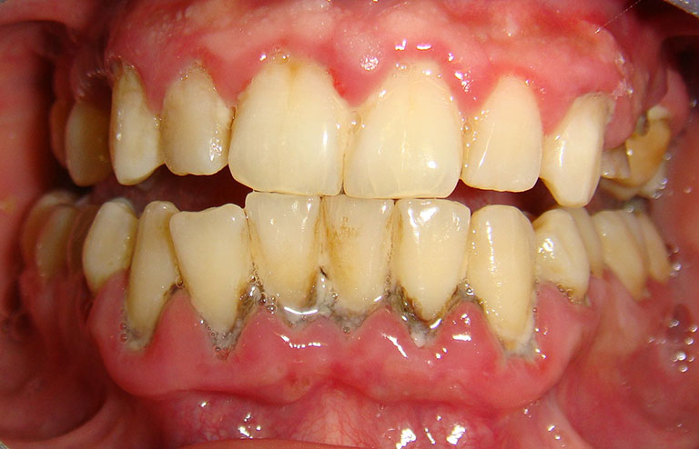 Tăng nguy cơ mắc bệnh lý răng miệng