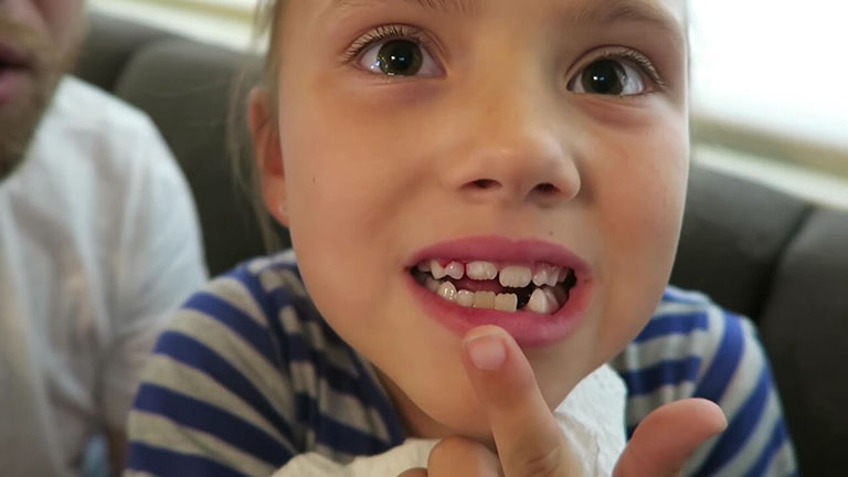răng vĩnh viễn của trẻ bị lung lay
