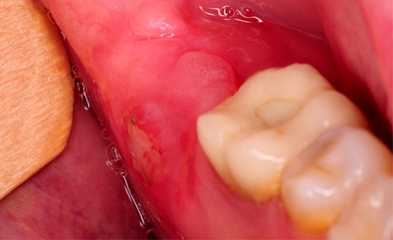 sưng nướu răng trong cùng hàm dưới có mủ