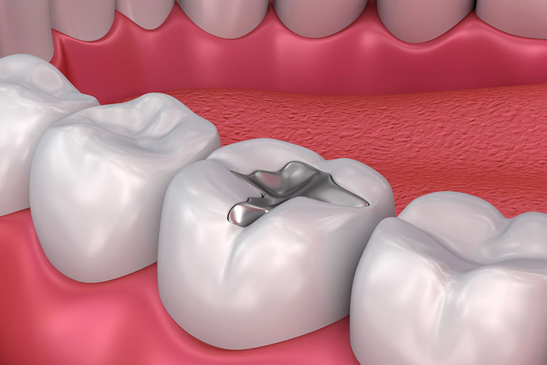 Trám răng giúp khắc phục khiếm khuyết hoặc mô răng bị hao mòn bằng vật liệu nhân tạo