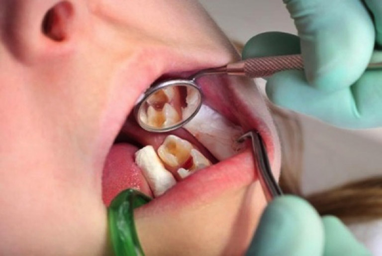Tình trạng răng