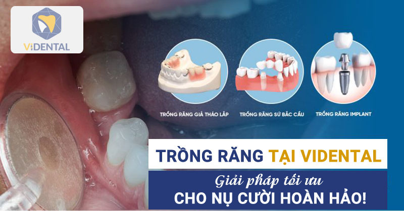 Trồng răng Implant là phương pháp đòi hỏi kỹ thuật cao