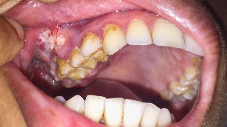 hình ảnh ung thư nướu răng