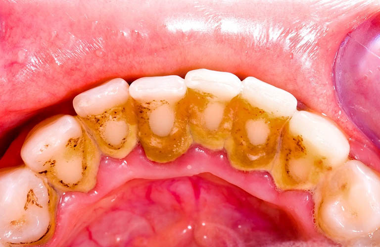 Tìm hiểu vôi răng có tự bong tróc ra được không, cách xử lý hiệu quả