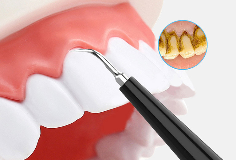 Cần sử dụng các dụng cụ chuyên biệt của bác sĩ Nha khoa để làm sạch hoàn toàn lượng vôi răng tích tụ
