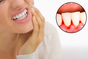 Chảy máu chân răng sau khi ngủ dậy bị bệnh gì