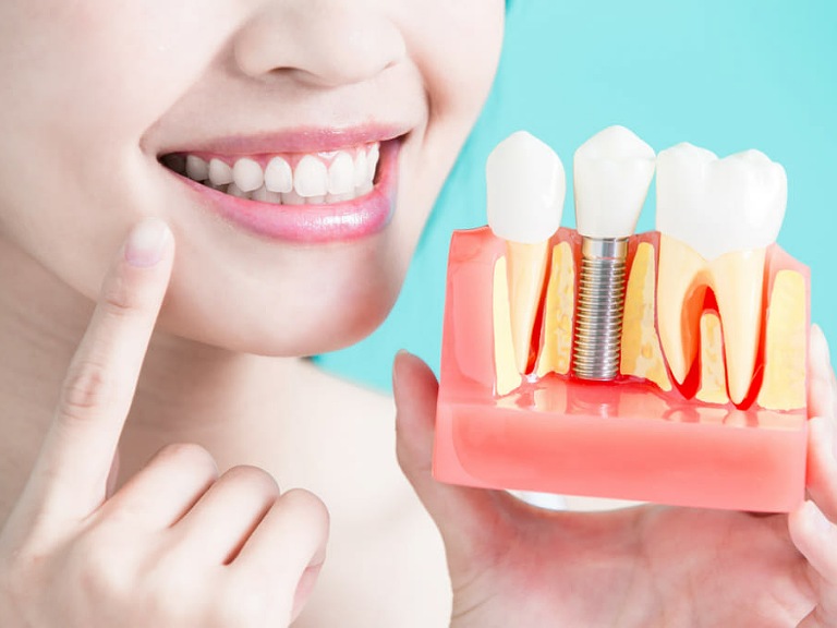 Biện pháp ngăn ngừa tiêu xương răng
