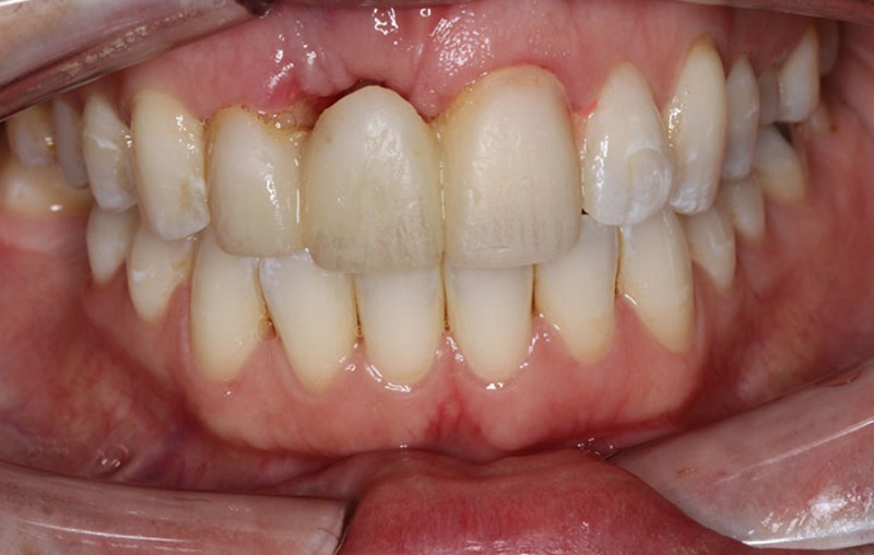 Răng sứ có bền hay không phụ thuộc rất nhiều vào chất liệu sử dụng 