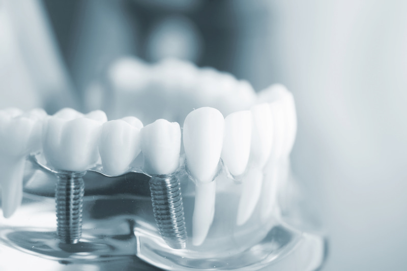Trồng răng sứ nguyên hàm tại địa chỉ không uy tín sẽ gây ra nhiều biến chứng