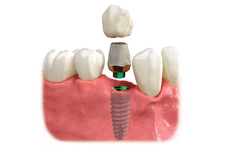 mất răng lâu năm có trồng implant được không
