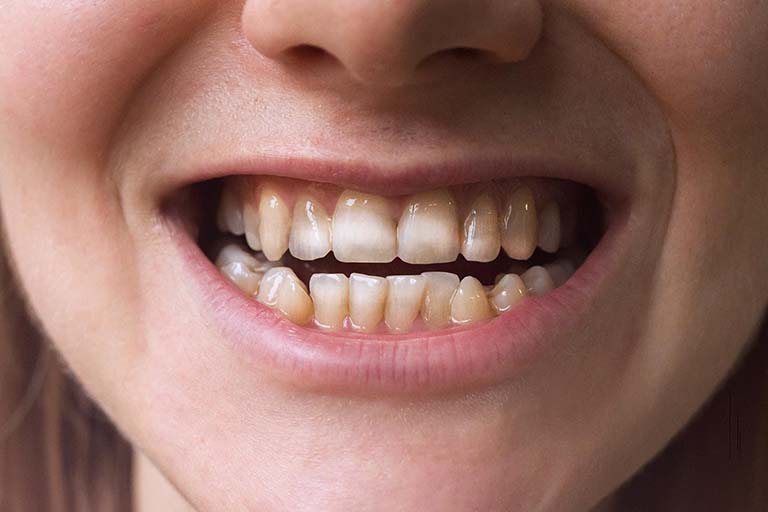  Thiểu sản men răng khiến răng trở nên nhạy cảm hơn so với khác 