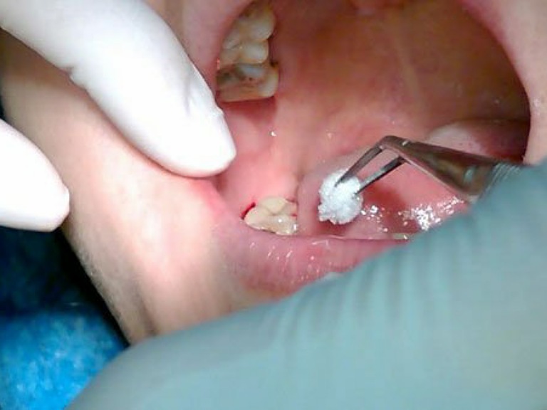 quá trình nhổ răng khôn tại Răng hàm mặt Trung ương