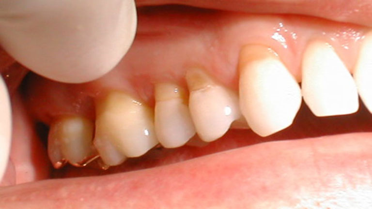 răng bị ăn mòn chân răng