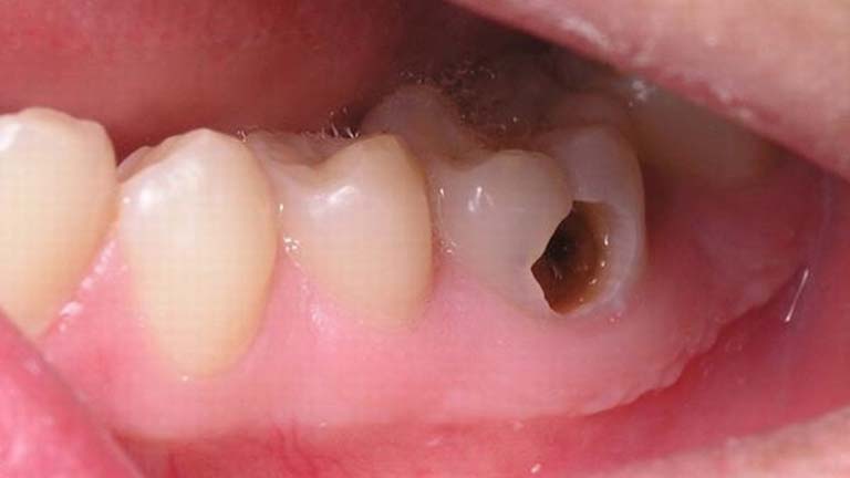 răng cấm bị sâu nặng