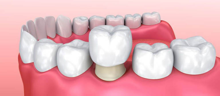 răng cấm bị sâu nặng phải làm sao