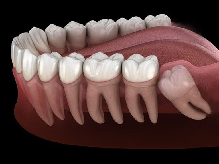 răng mọc ngầm trong xương