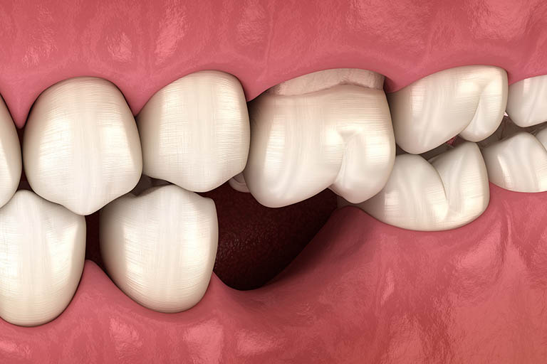 trồng răng hàm loại nào tốt
