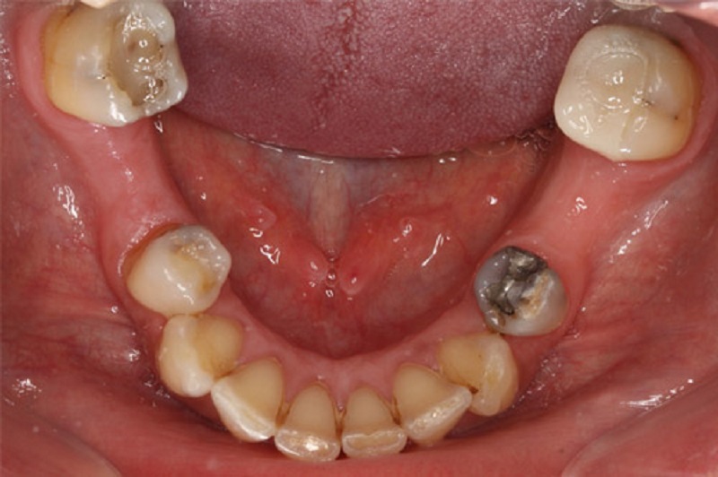 Tình trạng răng của bác Kha trước khi trồng