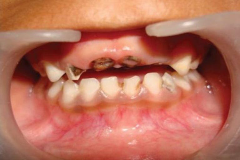 răng bé bị sún cụt viêm tủy