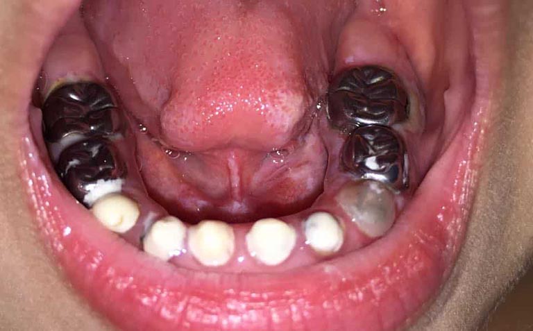 răng bé bị sún cụt viêm tủy