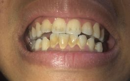 răng ố vàng và có cao răng