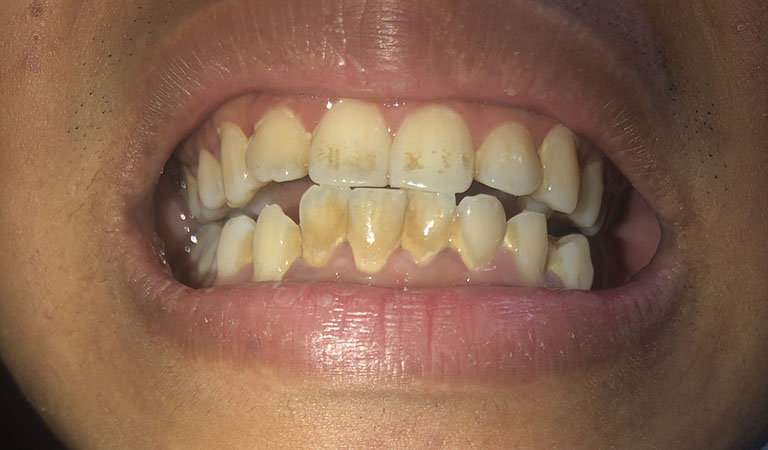 răng ố vàng và có cao răng