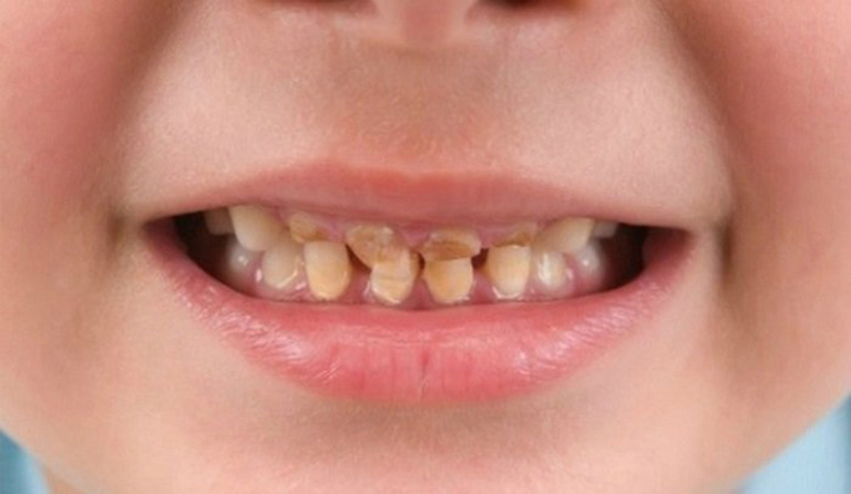 Bệnh ăn mòn chân răng ở trẻ em