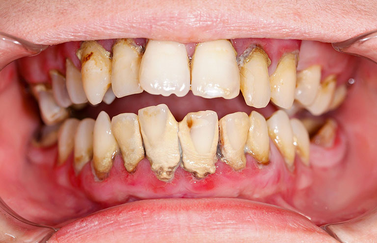 Bị viêm lợi có nên lấy cao răng không