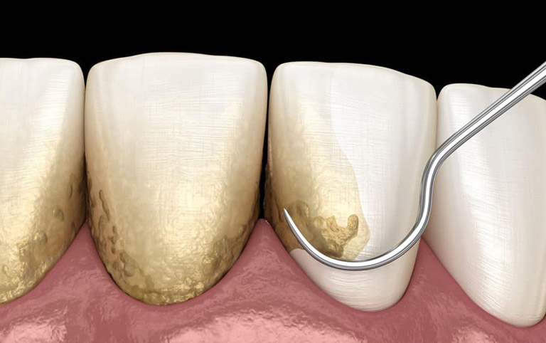 Quy trình lấy cao răng ở người viêm lợi