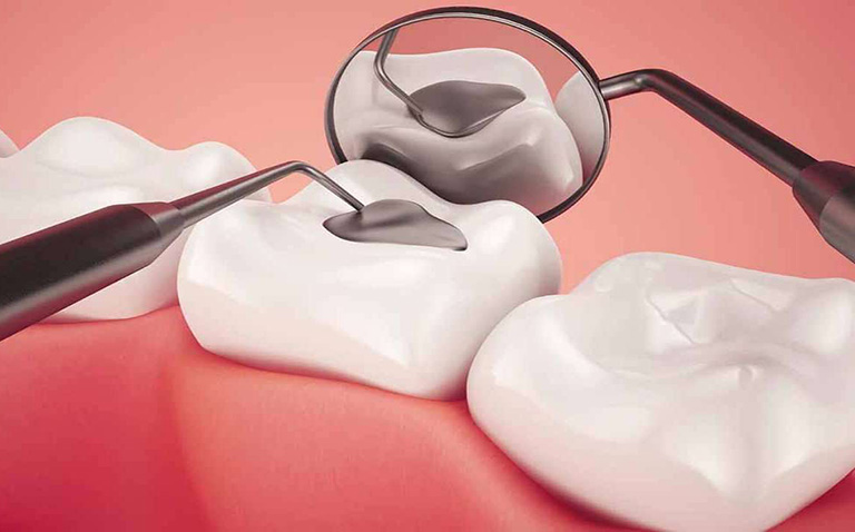 Điều trị sâu ngà răng phục hồi bằng composite