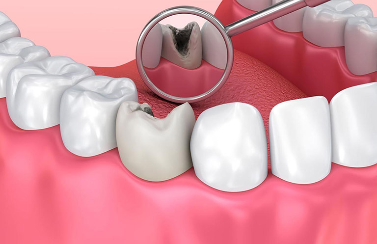 chỉ định điều trị sâu ngà răng phục hồi bằng composite