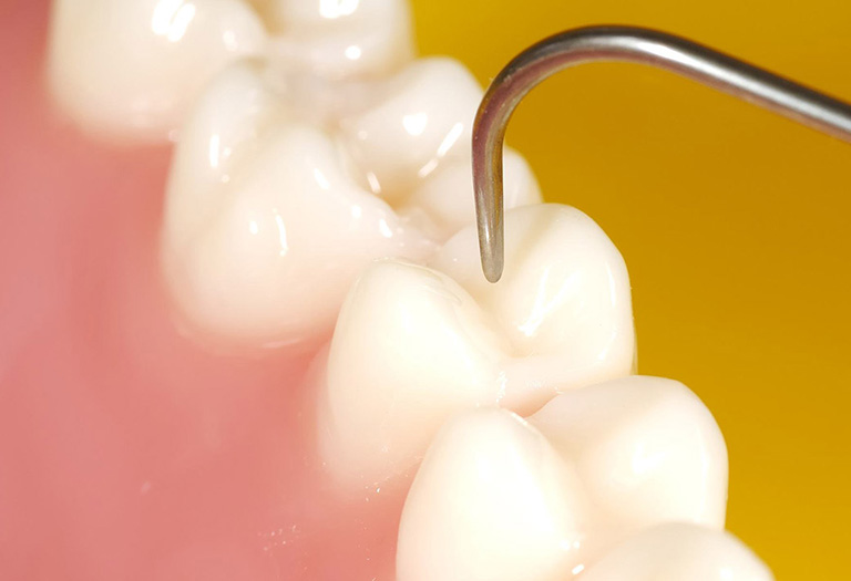 Lợi ích của điều trị sâu ngà răng phục hồi bằng composite