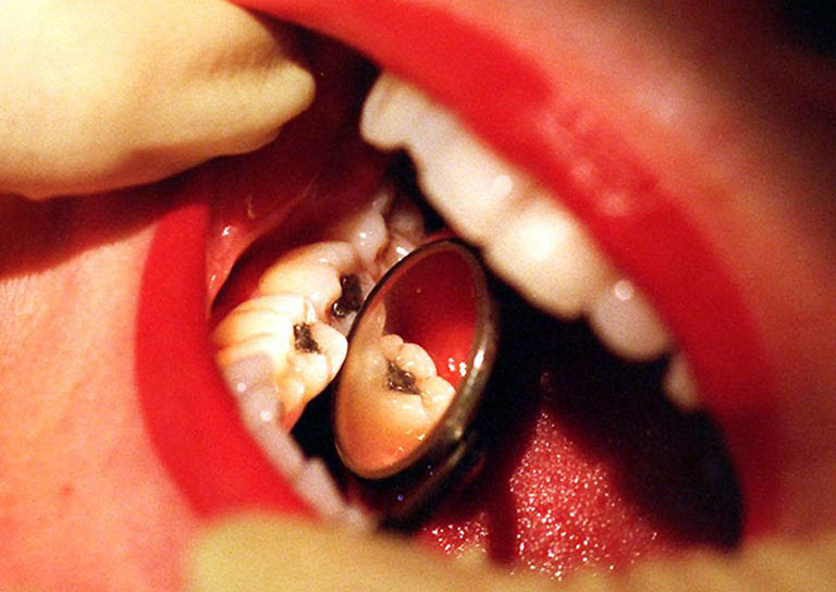 Chữa sâu ngà răng phục hồi bằng Eugenate thường được chỉ định để trám tạm