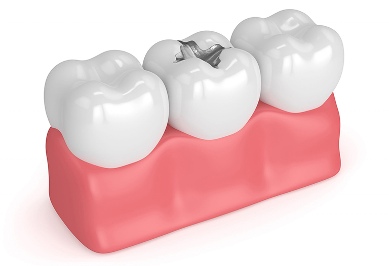 Điều trị sâu ngà răng phục hồi bằng Eugenate