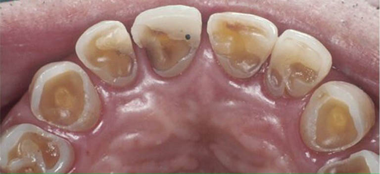 triệu chứng lộ ngà răng