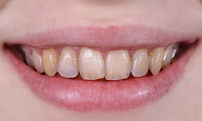 Không mài kẽ răng cho những trường hợp bị thiểu sản men răng hoặc mòn răng