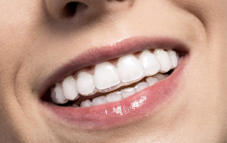 Niềng răng trong suốt Invisalign có tính thẩm mỹ cao hơn so với niềng răng mắc cài